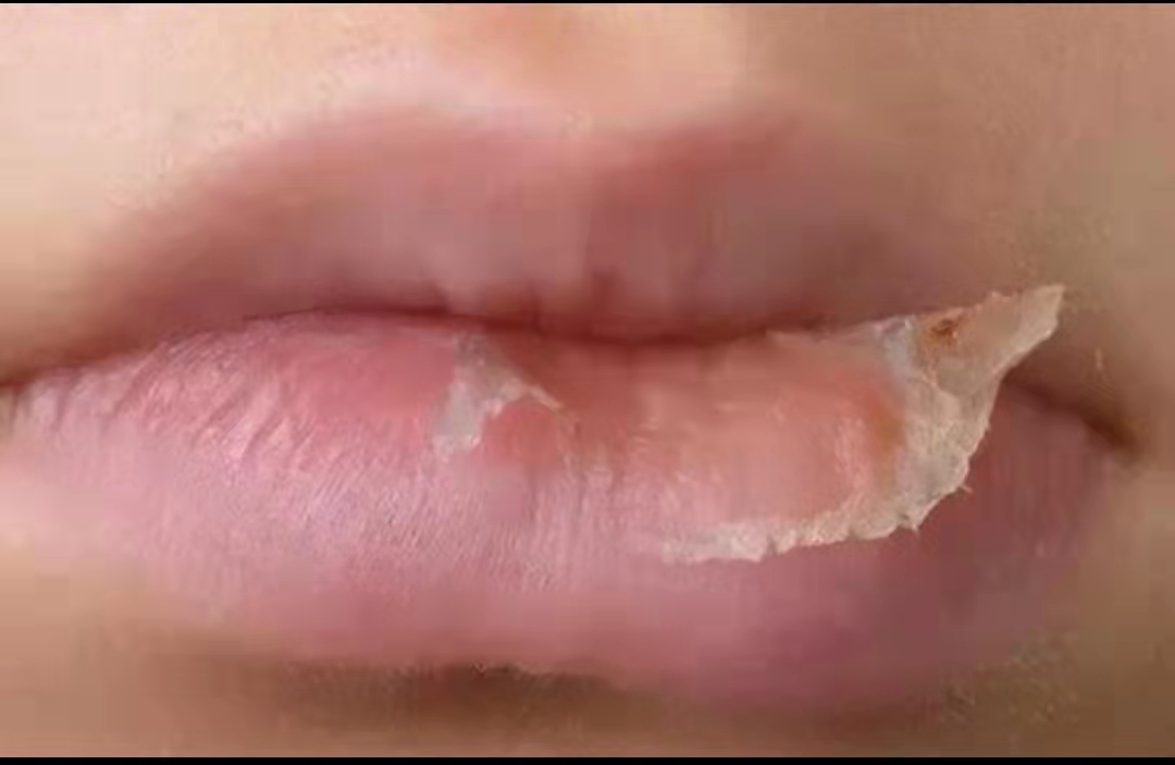 小孩嘴唇干裂出血怎么快速恢复,小孩嘴唇干裂起皮最快治好的方法