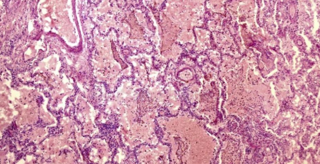 感染病毒,死于窒息:肺里究竟发生了什么?