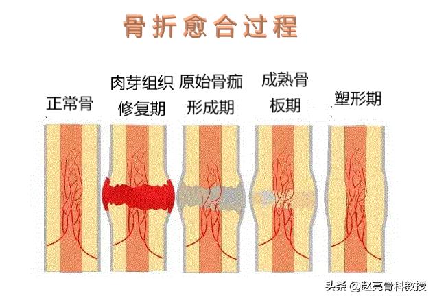 骨科咨询骨折后怎样恢复得快,骨科医生给骨折的病人该怎么治疗