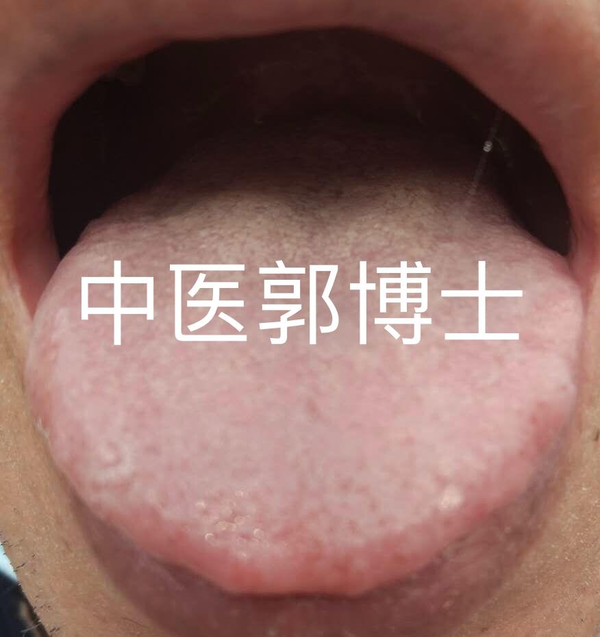 肠易激综合症，喝红米薏苡粥？杯水车薪！推荐此方，解决腹痛腹泻