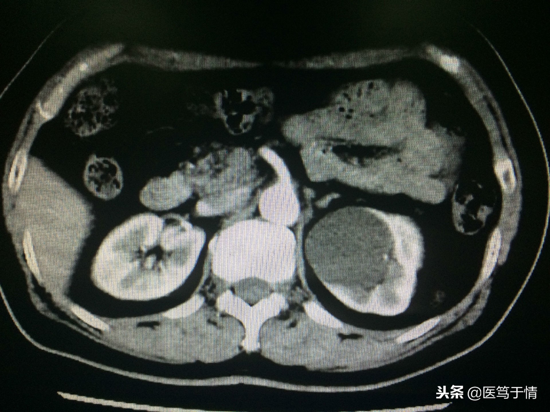 肾囊肿10*9mm需要做手术么,肾囊肿14mm用做手术吗