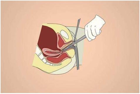 为什么会得巧克力囊肿女性要警惕,巧克力囊肿严重还是卵巢囊肿严重