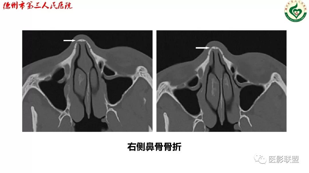 鼻骨骨折影像,鼻骨骨折dr影像表现