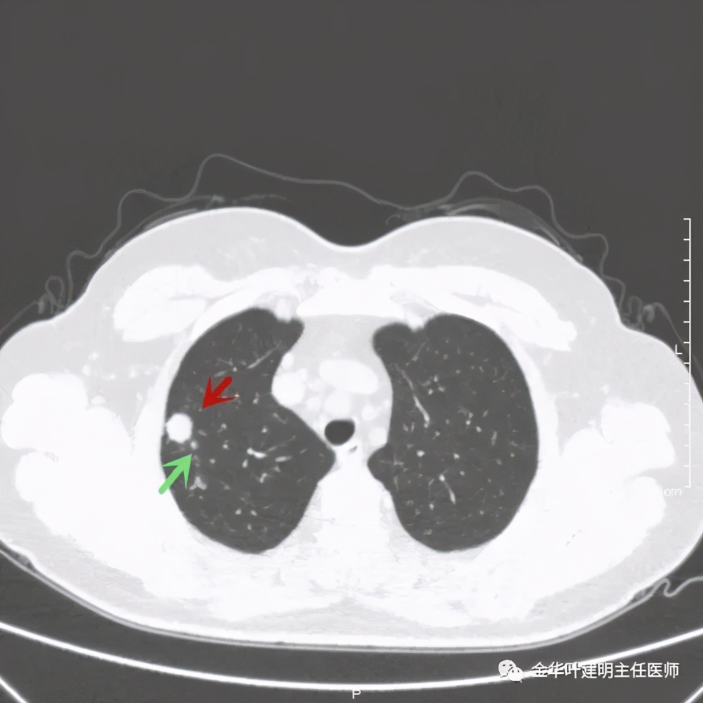 右上肺结节灶一般是什么癌,右上肺恶性肿瘤是肺癌吗