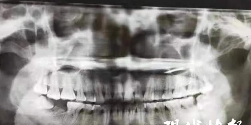 女性智齿发炎是什么原因,一个女孩智齿反复发炎的新闻