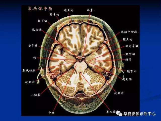 电子版头颅ct与mri断层解剖,头颅mri血管解剖与分段详解