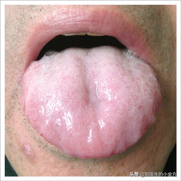 中医舌诊图解100例,中医舌诊图与舌诊口诀