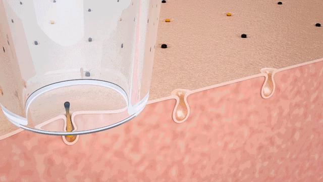 黑头闻起来很臭,黑头很痛怎么回事