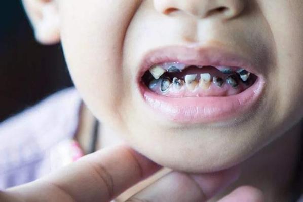 3岁儿童满口“小黑牙”,元凶并不是糖