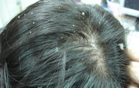 刚洗完头就有大量头皮屑怎么治,刚洗完头头皮屑很大块是什么原因