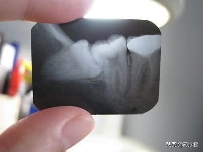 智齿一定要拔了有什么明显的变化,智齿拔完脸变化过程