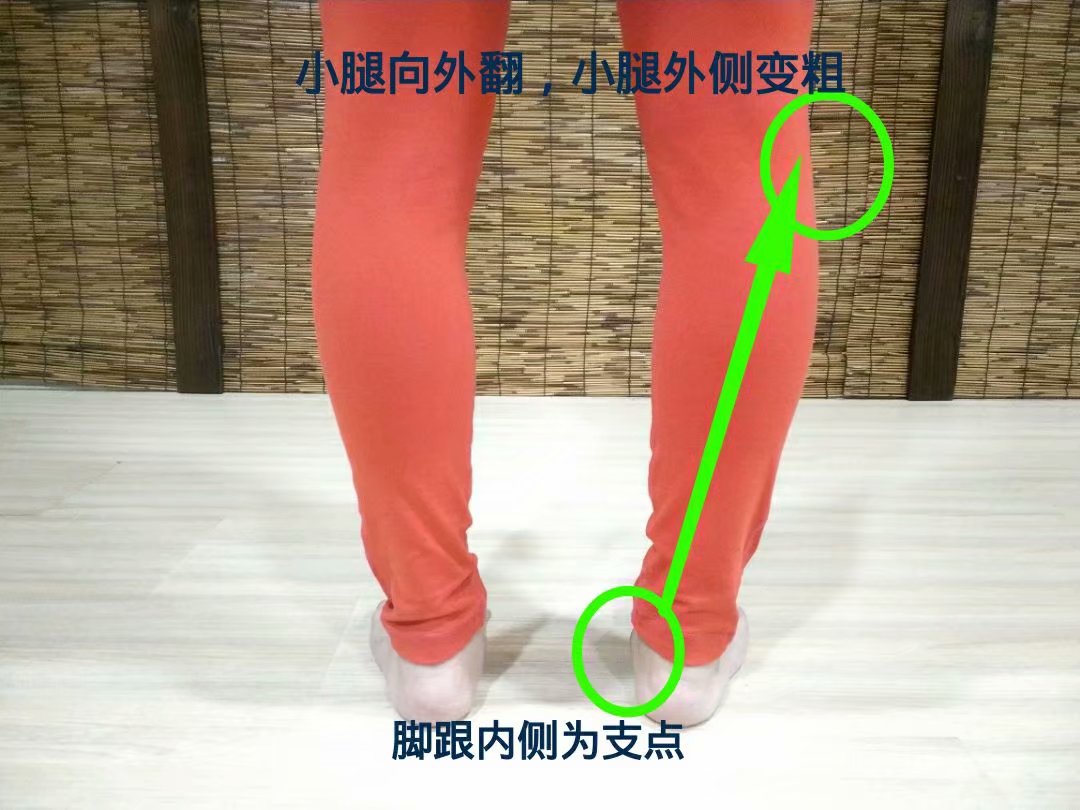 大脚趾外翻怎么锻炼恢复正常,大脚趾外翻矫正危害