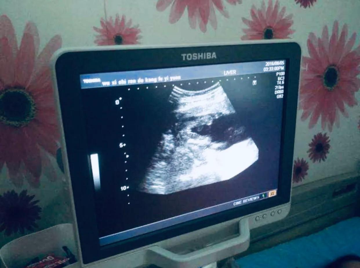 怀孕流血但还是一直有孕吐,早孕有什么方法自然流出来