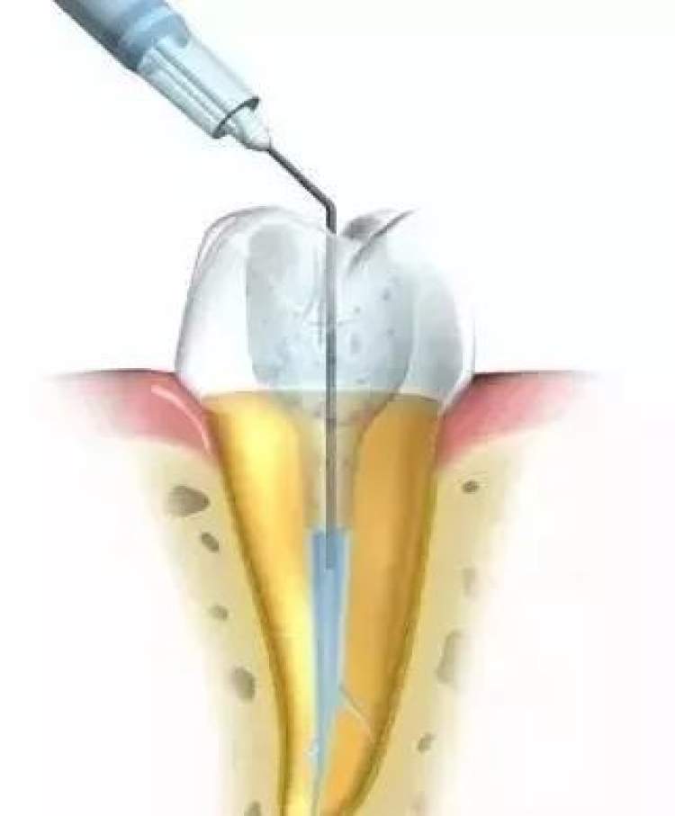 明明看不见蛀牙，却要接受根管治疗，究竟是怎么回事？