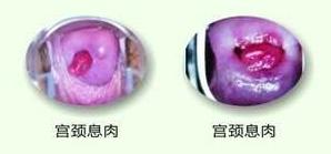 出血十天是宫颈癌吗,绝经后出血可能是宫颈癌