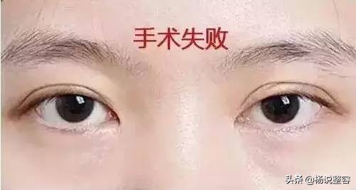 全切双眼皮是永久的么,全切双眼皮是永久吗