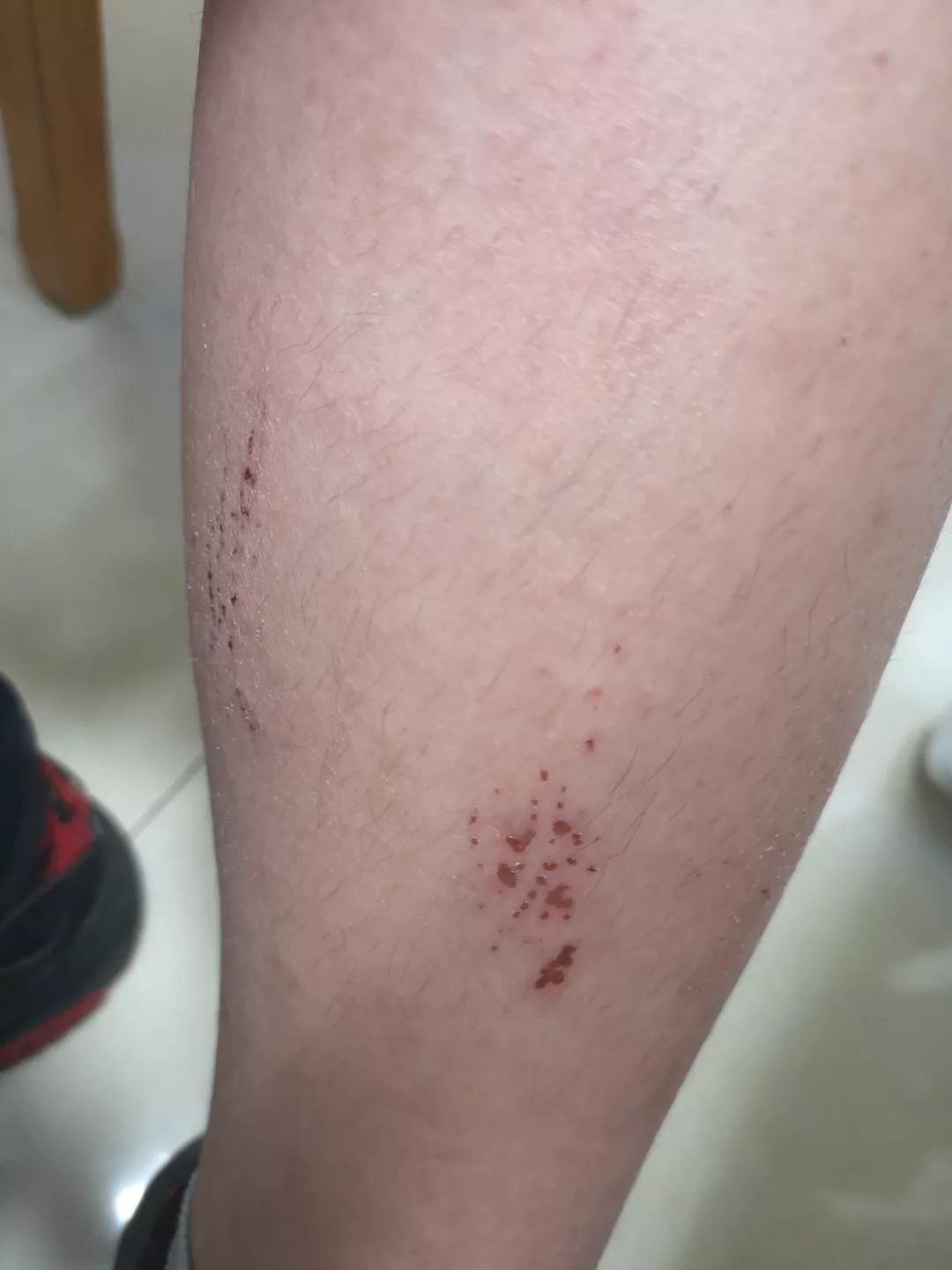 色素性紫癜性皮肤病是啥,色素性紫癜性皮肤病是什么