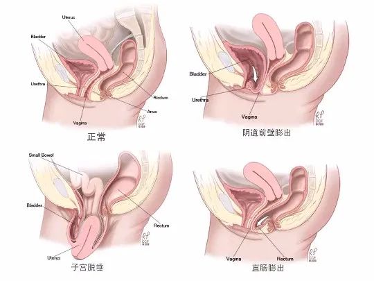 盆底肌损伤会导致便秘么,产后便秘跟盆底肌有关系吗