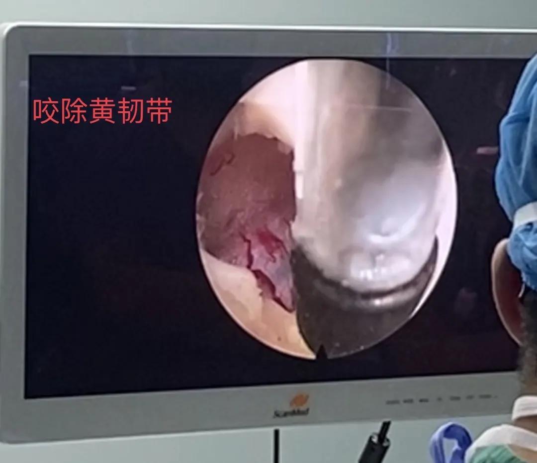 渭南治腰间盘突出哪家最好,脊柱神经外科手术