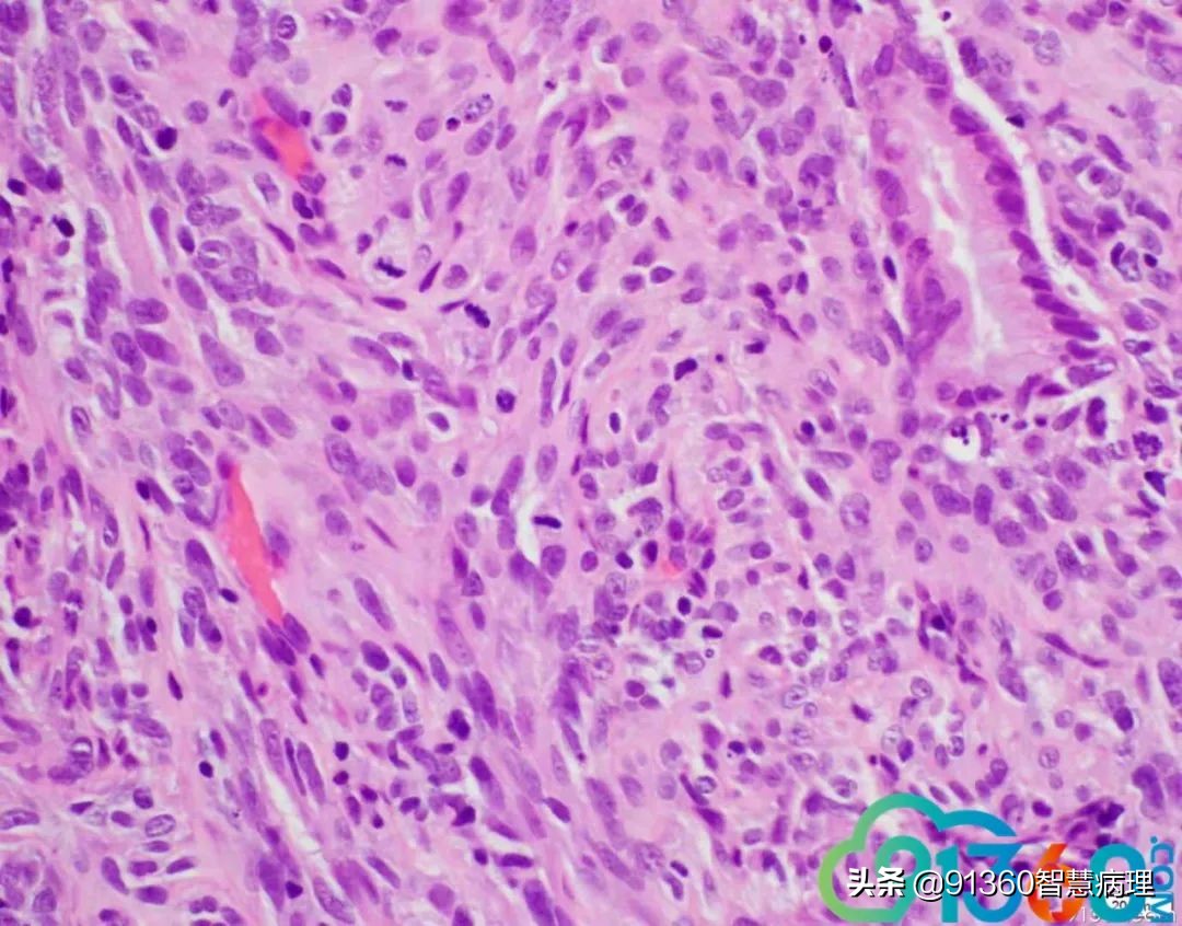 宫颈腺癌silvaa型严重吗,宫颈腺癌silvab型复发率高吗
