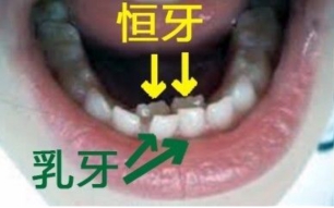 乳牙应该拔还是不拔,宝宝新牙齿出来了旧牙齿不松动