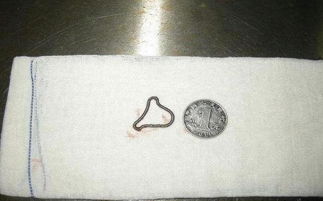 皮埋避孕和上环哪个副作用大,上环避孕的副作用