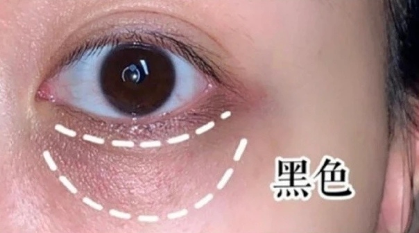 小孩子长黑眼圈怎么办,没熬夜为什么长黑眼圈