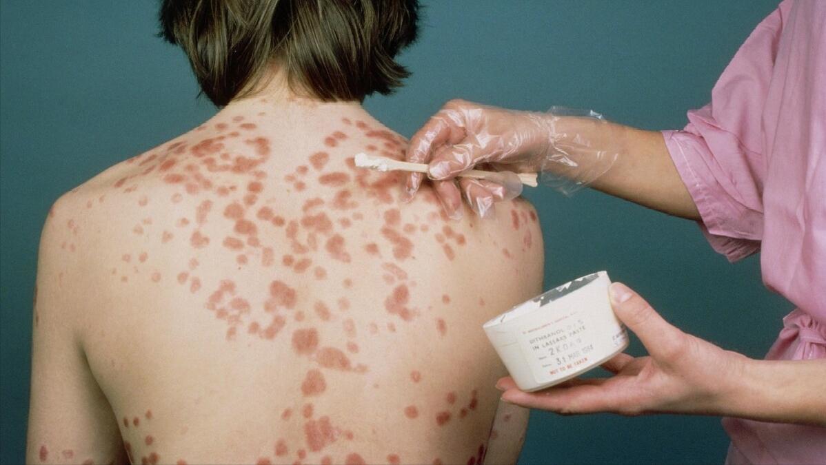 牛皮癣患者多吃哪些蔬菜有好处呢,牛皮癣可以吃的水果都有哪些