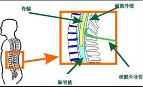 腰椎间盘突出有药酒可以治吗,腰椎间盘突出有药缓解吗