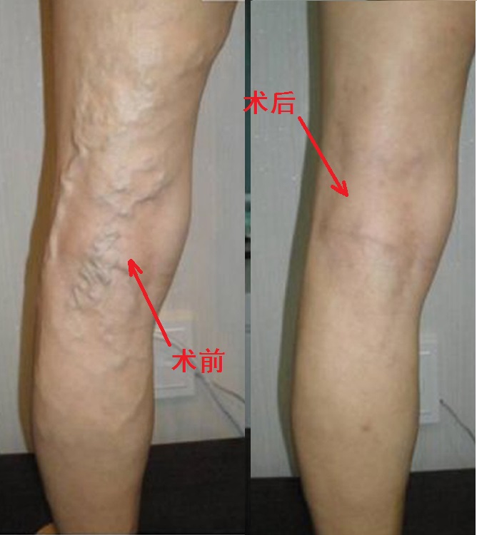 静脉曲张、静脉血栓，有区别？有联系？要处理？请听专业的回答