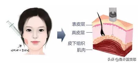 关于除皱针你知道多少,关于微整形你想知道的都在这里