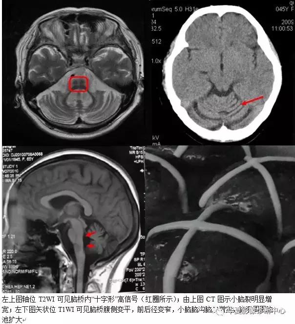颅脑核磁影像解剖图谱,颅脑mr增强影像图片
