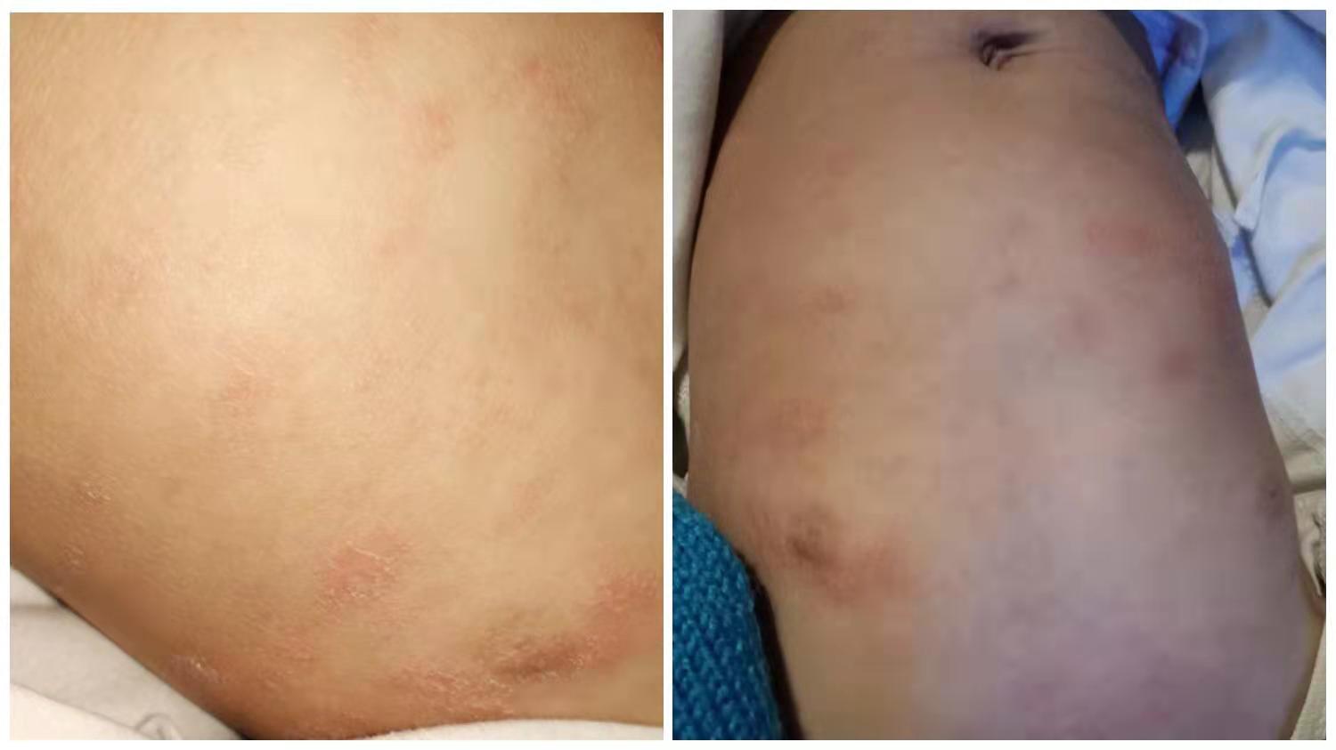 宝宝对牛奶蛋白过敏起湿疹怎么办,牛奶蛋白过敏宝宝能喝正常奶粉吗