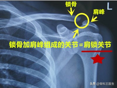 武磊肩锁关节脱位怎么治疗,武磊肩部受伤