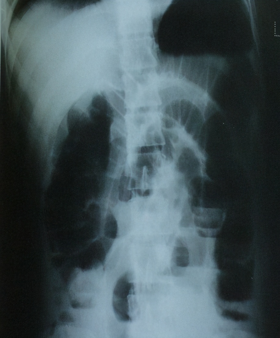 拉不出便便怎么办快速解决,拉不出便便怎么办吃什么能消化