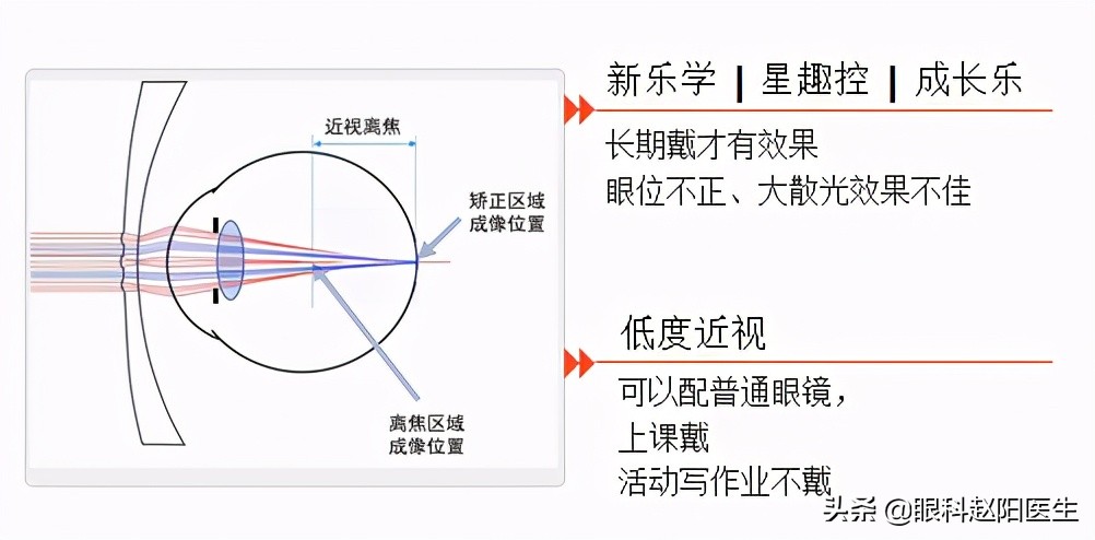 近视眼轴缩短什么原因,缩短眼间距的方法
