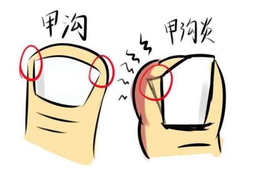 甲沟炎的症状及治疗方法,甲沟炎是什么症状怎样治疗