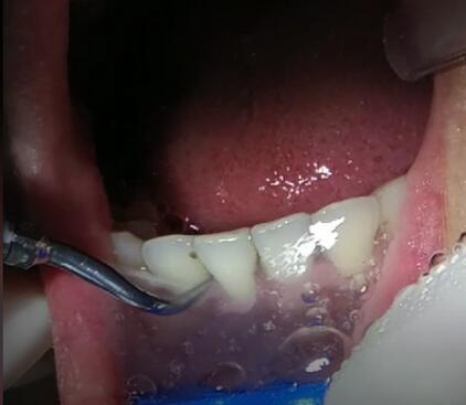 牙齿美白选什么洗牙方式,洗牙美白一般去哪里