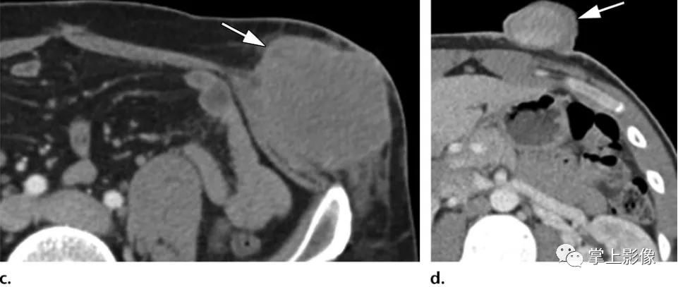 腹壁病变诊断思路,腹部影像诊断读片入门视频