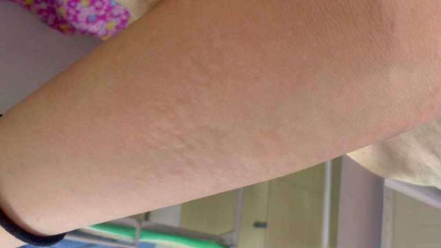 麻疹是什么病机,麻疹与荨麻疹的区别有哪些