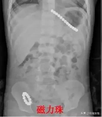 8岁男孩误吞5厘米钢钉,惊险9岁男孩误吞3厘米图钉