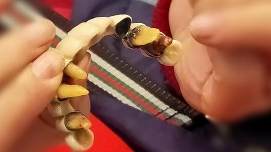 牙齿缺失,需要及时镶牙,口腔医生:镶牙前需要做这些准备工作