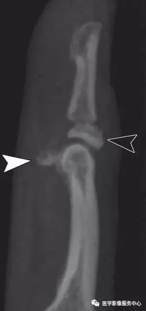 手腕撕脱性骨折一年了还隐隐作痛,手腕三角骨撕脱骨折症状有哪些