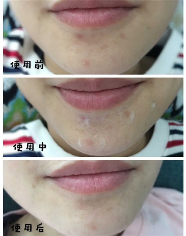 为什么一出门就脸红,夏天一出门就脸红怎么办