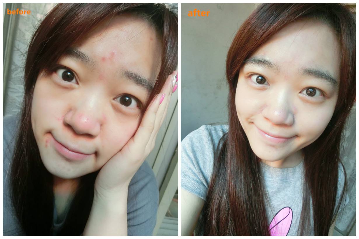 脸上有闭合性粉刺怎么去除,满脸闭合性粉刺痘痘怎么去除