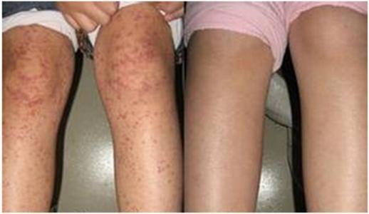 过敏性紫癜体质差会一直反复发作,过敏性紫癜看血液科专家可以吗