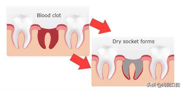 什么是干槽症啊,非腐败干槽症