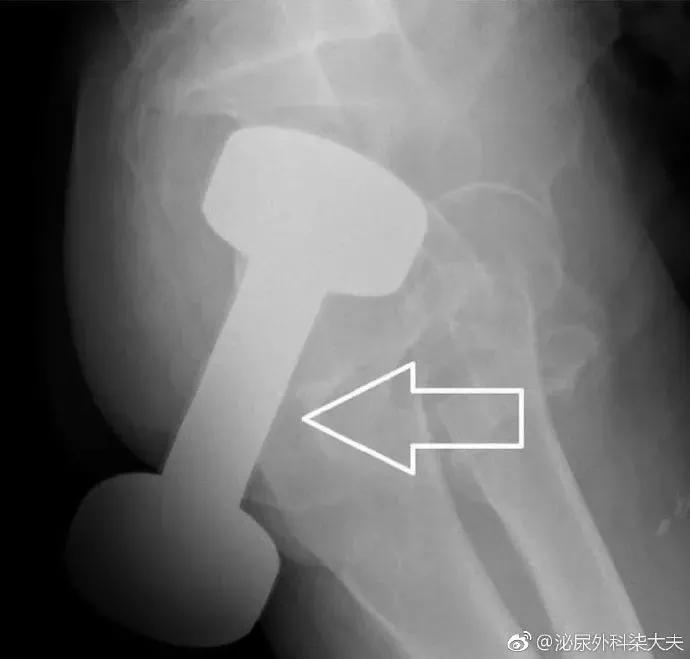 星医百可以长期吃吗,罗非鱼塞进直肠多长时间