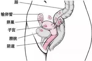 剖腹产子宫内膜异位痛,剖腹产生二胎子宫破裂