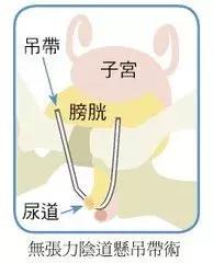 笑得尿失禁怎么办,笑会流尿出来是什么原因